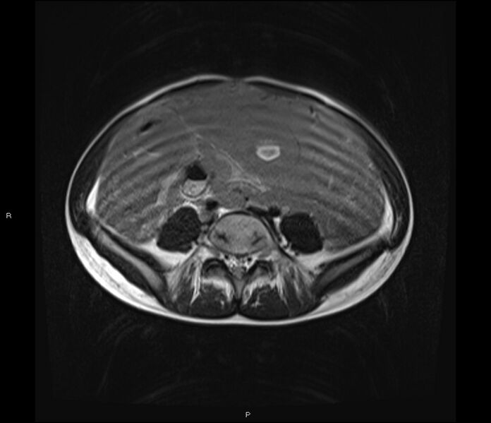 File:Burkitt lymphoma (bowel) (Radiopaedia 68839-78557 Axial T2 42).jpg