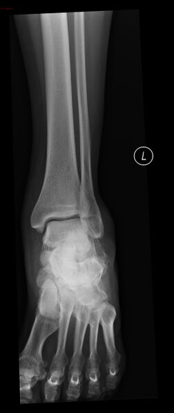 File:Calcaneal fracture and associated spinal injury (Radiopaedia 17896-17655 Frontal 1).jpg