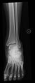 Calcaneal fracture and associated spinal injury (Radiopaedia 17896-17655 Frontal 1).jpg