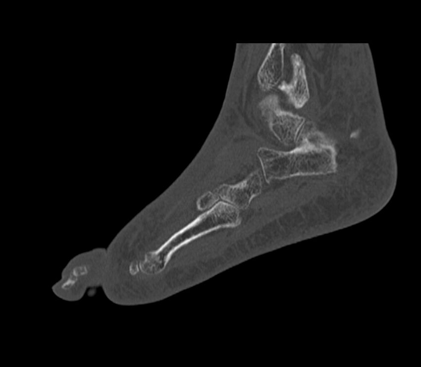 Calcaneal tuberosity avulsion fracture (Radiopaedia 22649-22668 Sagittal bone window 12).jpg