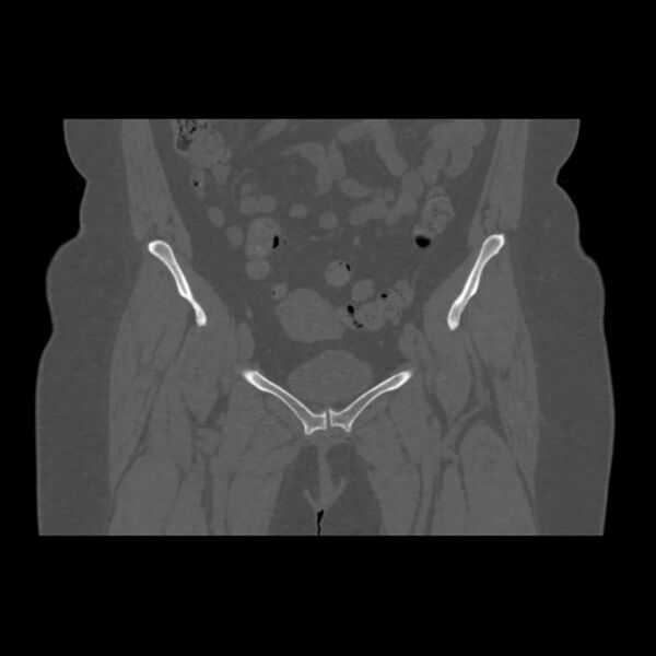 File:Calcific tendinitis of the gluteus medius muscle (Radiopaedia 66998-76318 Coronal bone window 17).jpg
