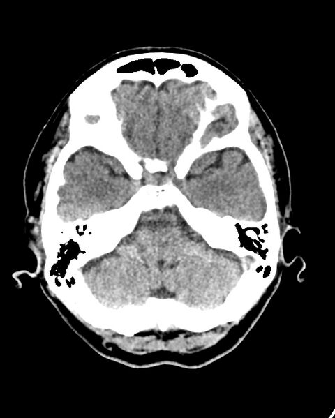 File:Calcified meningioma (Radiopaedia 74361-85243 Axial non-contrast 39).jpg