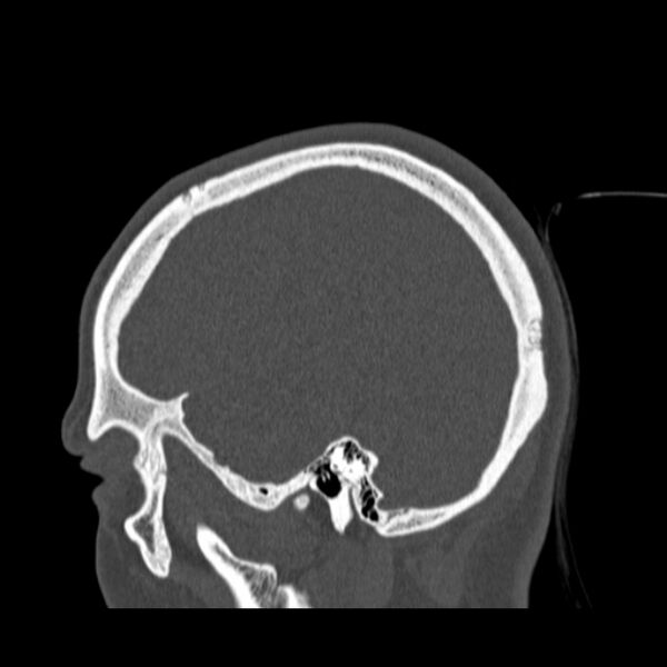 File:Calvarial osteoma (Radiopaedia 36520-38079 Sagittal bone window 27).jpg