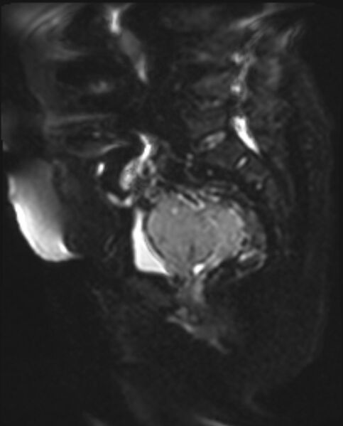 File:Cancer cervix - stage IIb (Radiopaedia 75411-86615 Sagittal DWI 13).jpg
