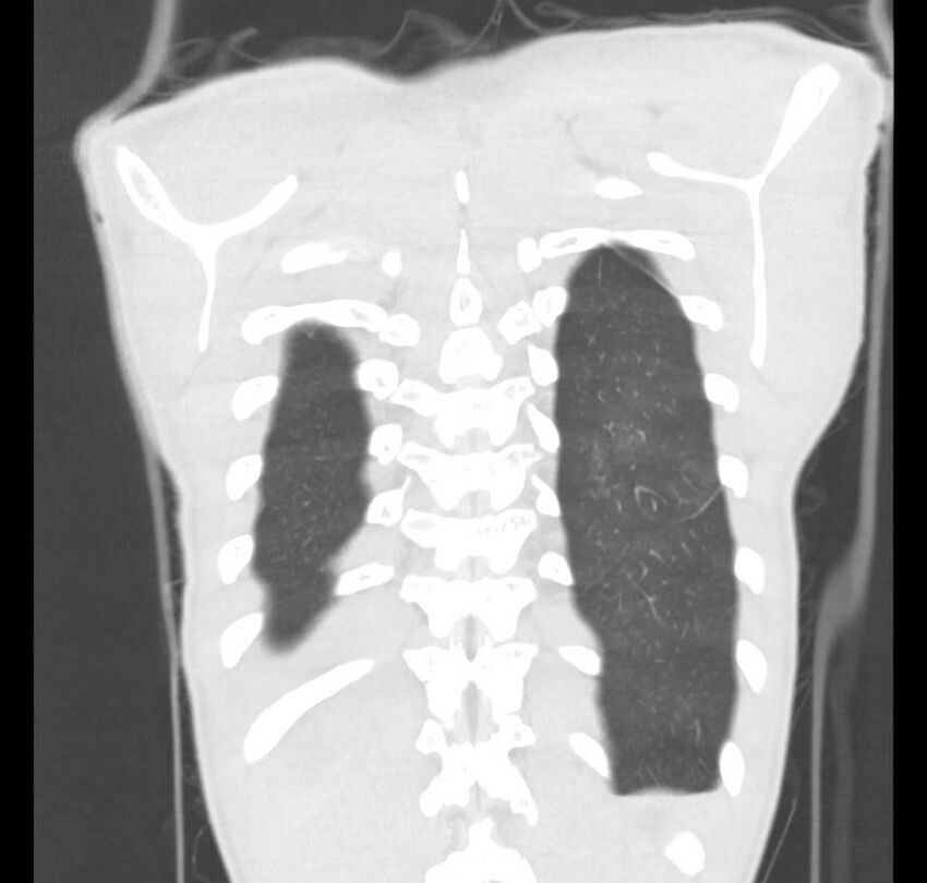 Cannabis-induced diffuse alveolar hemorrhage (Radiopaedia 89834-106946 Coronal lung window 9).jpg