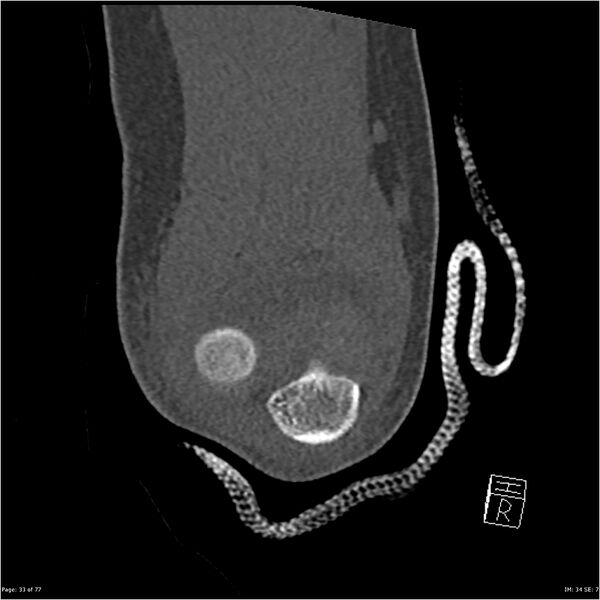 File:Capitellum fracture (Radiopaedia 23352-23426 Coronal bone window 33).jpg