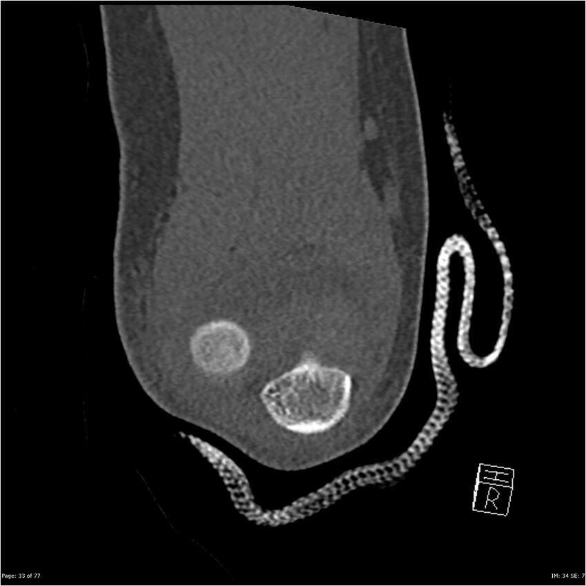 Capitellum fracture (Radiopaedia 23352-23426 Coronal bone window 33).jpg