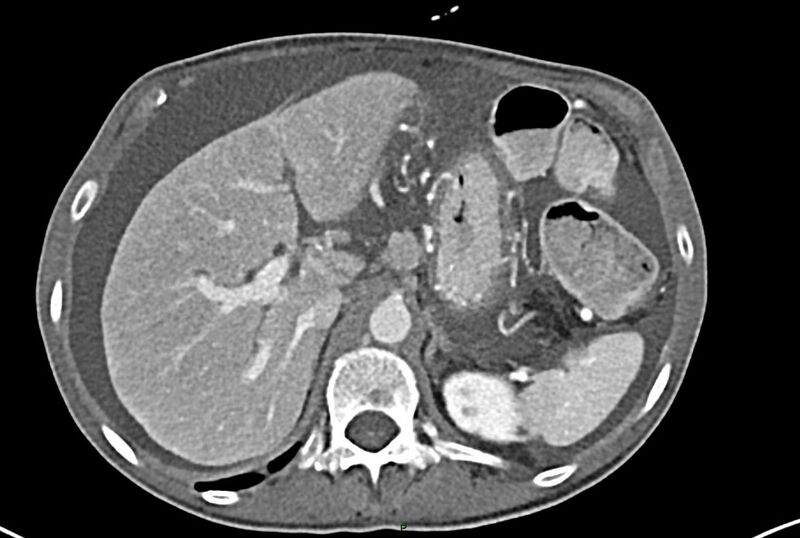 File:Carcinoid mesenteric tumor complicated by chylous ascites (Radiopaedia 76312-87953 A 17).jpg