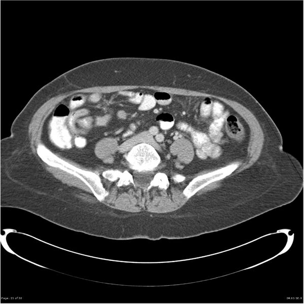 File:Carcinoid tumor of the ileum with metastasis to orbit (Radiopaedia 28165-28425 A 15).jpg