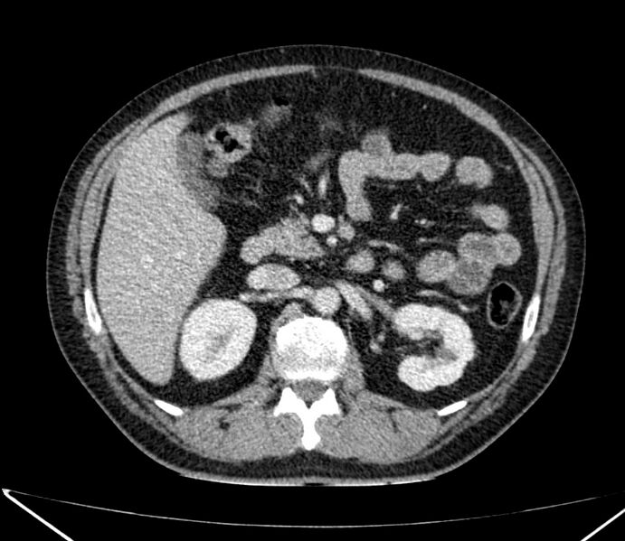 File:Carcinoid tumor with hepatic metastases (Radiopaedia 22651-22670 C 44).jpg