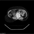 Carcinoma cervix- recurrence (Radiopaedia 34702-36137 B 27).jpg