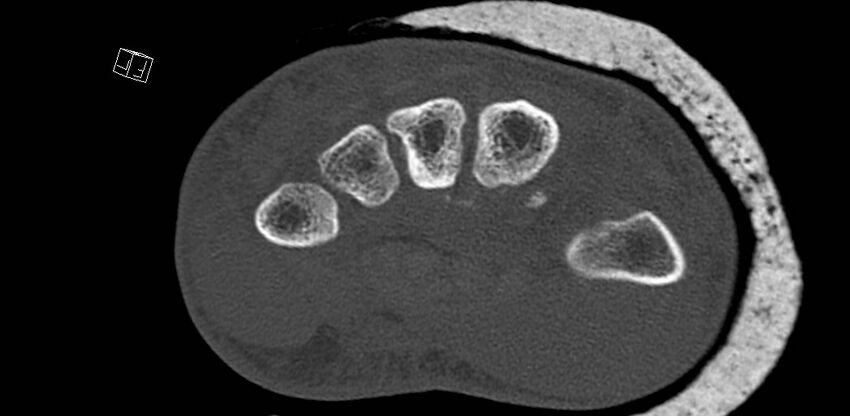 Carpal fractures (smart watch impaction) (Radiopaedia 55844-62430 Axial bone window 45).jpg