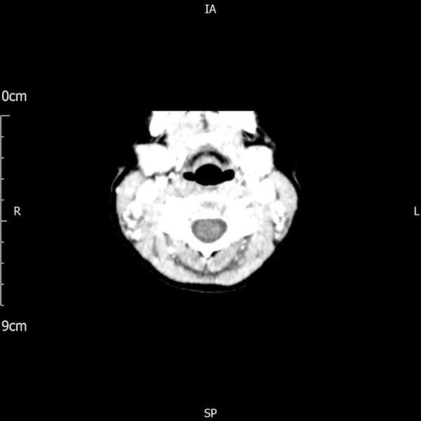 File:Cavernous sinus thrombosis (Radiopaedia 79414-92510 Axial Brain 10).jpg