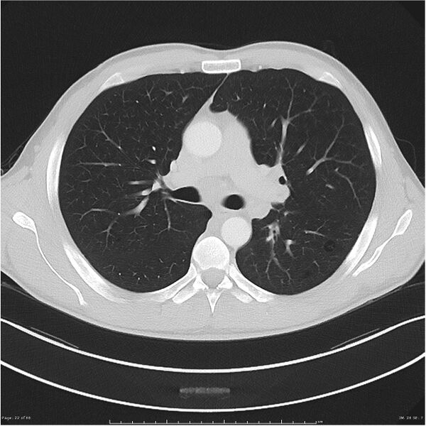 File:Cavitating lung cancer (Radiopaedia 25796-25945 Axial lung window 22).jpg