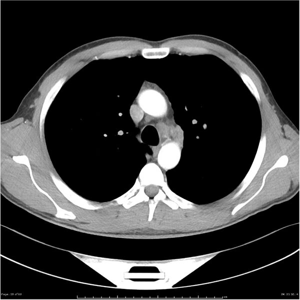 File:Cavitating lung cancer (Radiopaedia 25796-25945 C+ arterial phase 18).jpg