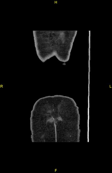 File:Cecal epiploic appendagitis (Radiopaedia 86047-102164 B 90).jpg