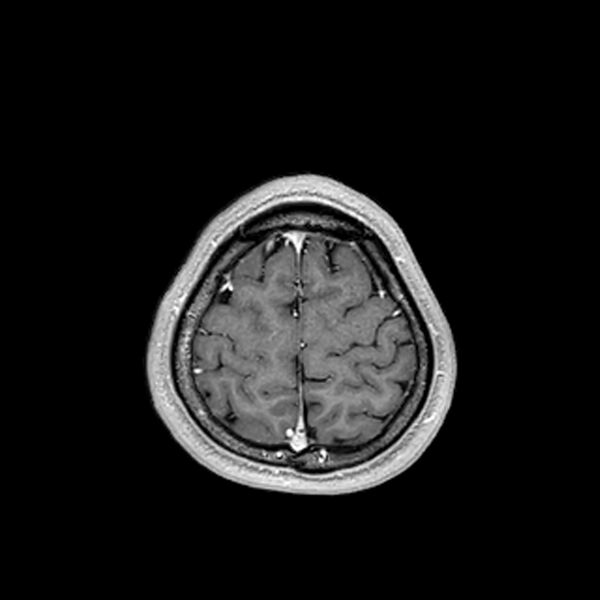 File:Central neurocytoma (Radiopaedia 79320-92380 Axial T1 C+ 203).jpg