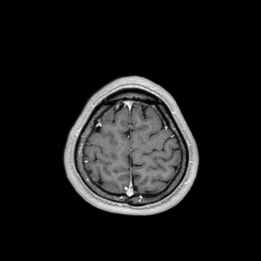 Central neurocytoma (Radiopaedia 79320-92380 Axial T1 C+ 203).jpg