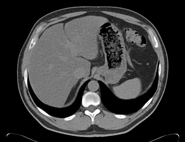 File:Centrilobular pulmonary emphysema (Radiopaedia 26808-26971 Axial non-contrast 41).jpg