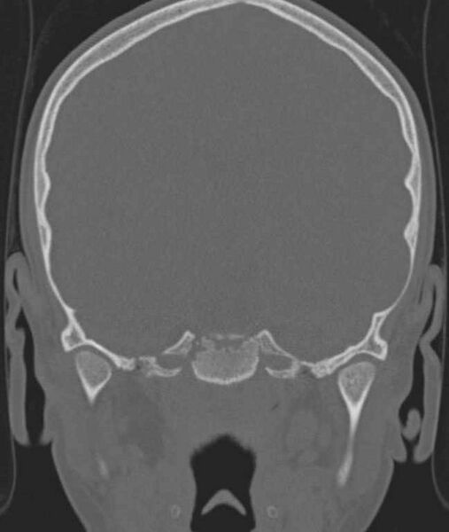 File:Cerebellar abscess (Radiopaedia 73727-84527 Coronal bone window 91).jpg