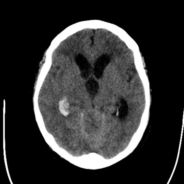 File:Cerebellar hemorrhage causing obstructive hydrocephalus (Radiopaedia 33989-35207 Axial non-contrast 22).jpg
