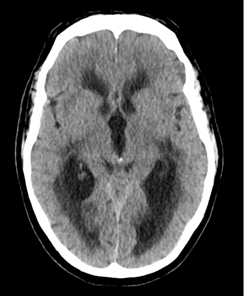 File:Cerebellar metastasis from lung adenocarcinoma (Radiopaedia 86690-102828 Axial non-contrast 14).png