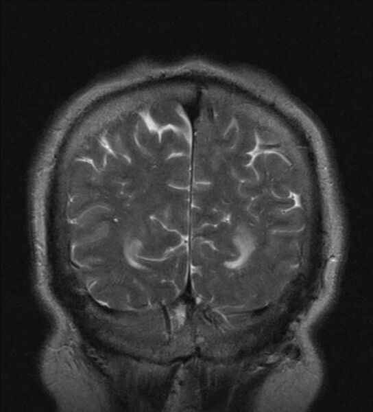File:Cerebellopontine angle meningioma (Radiopaedia 24459-24764 Coronal T2 22).jpg