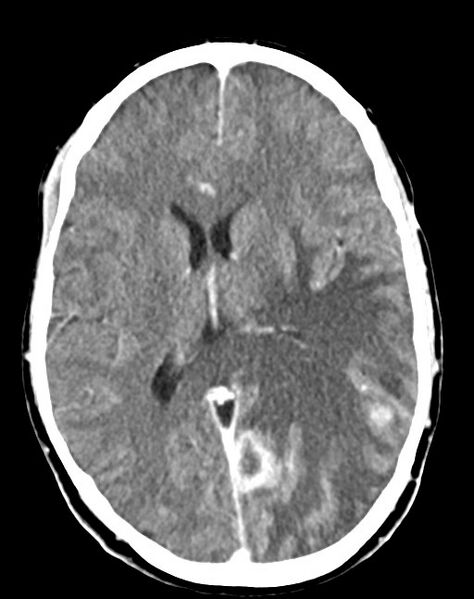 File:Cerebral abscesses (Radiopaedia 70458-80568 Axial Contrast 35).jpg