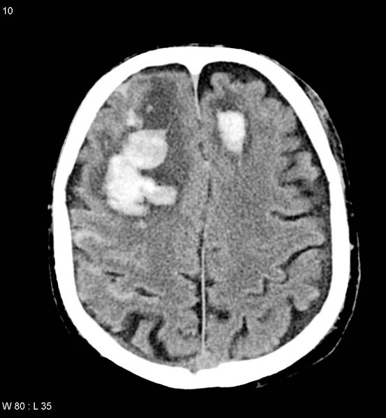 File:Cerebral abscesses secondary to contusions (Radiopaedia 5201-22213 Axial non-contrast 3).jpg