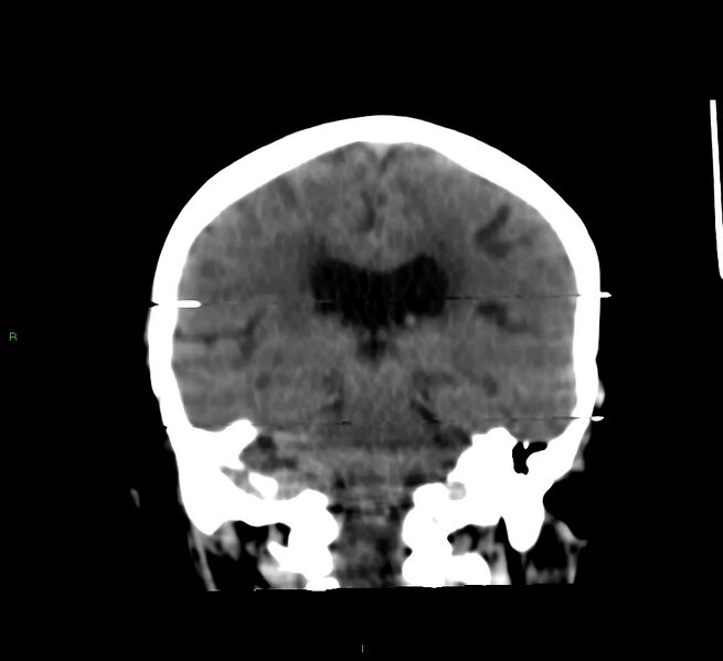 File:Cerebral amyloid angiopathy-associated lobar intracerebral hemorrhage (Radiopaedia 58377-65514 Coronal non-contrast 29).jpg