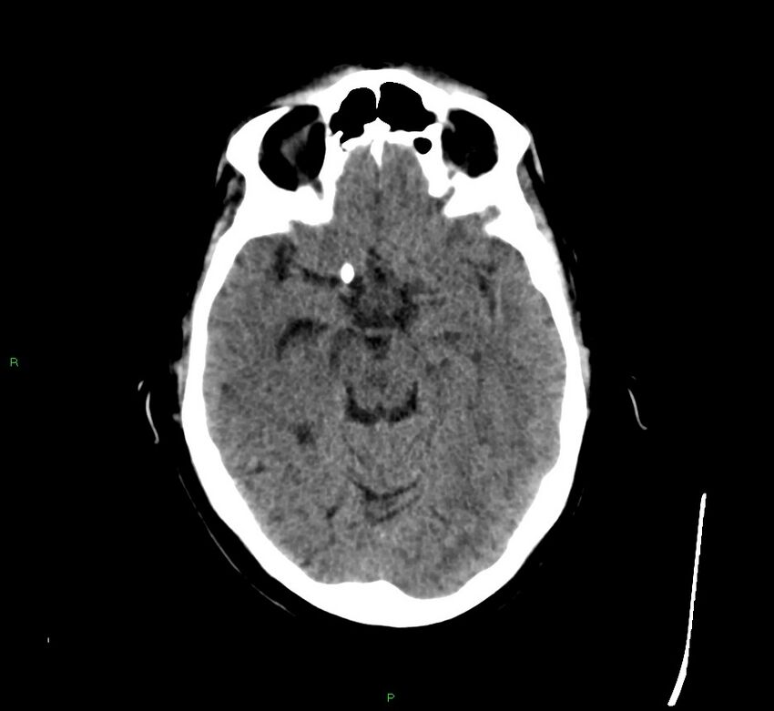 Cerebral amyloid angiopathy-associated lobar intracerebral hemorrhage (Radiopaedia 58529-65681 Axial non-contrast 33).jpg