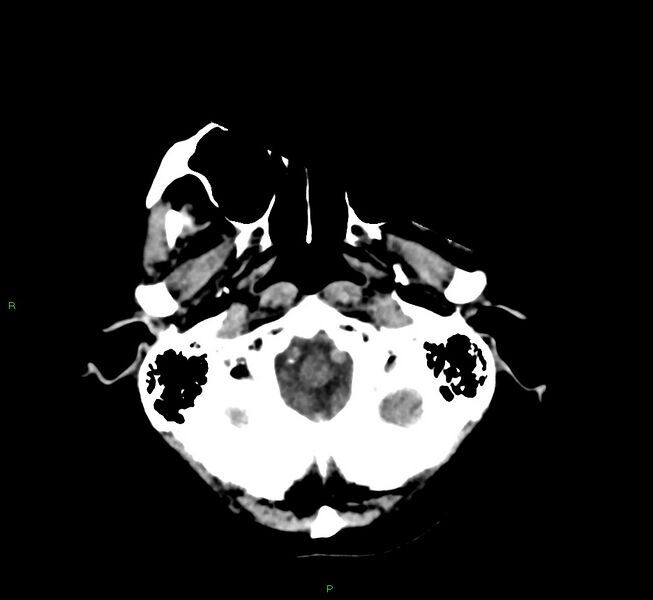 File:Cerebral amyloid angiopathy-associated lobar intracerebral hemorrhage (Radiopaedia 58530-65688 Axial non-contrast 45).jpg