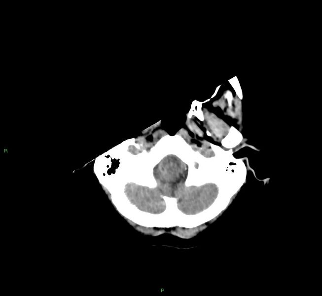 File:Cerebral amyloid angiopathy-associated lobar intracerebral hemorrhage (Radiopaedia 58754-65975 Axial non-contrast 52).jpg