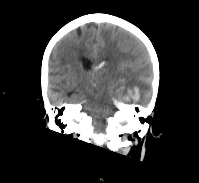 File:Cerebral amyloid angiopathy-associated lobar intracerebral hemorrhage (Radiopaedia 58754-65975 Coronal non-contrast 31).jpg