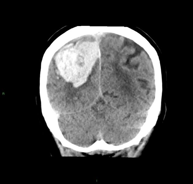 File:Cerebral amyloid angiopathy-associated lobar intracerebral hemorrhage (Radiopaedia 59356-66716 Coronal non-contrast 19).jpg