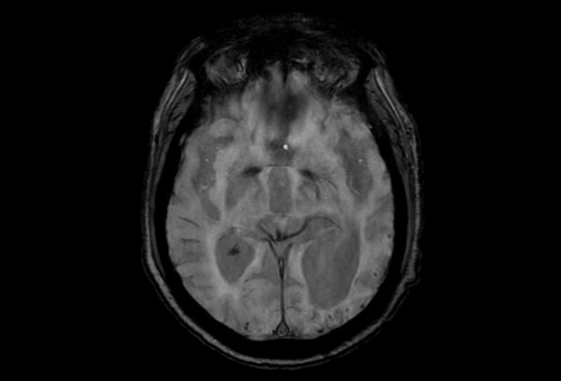 File:Cerebral amyloid angiopathy (Radiopaedia 86671-102792 Axial Gradient Echo 30).jpg