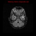 Cerebral and orbital tuberculomas (Radiopaedia 13308-13311 Axial FLAIR 7).jpg