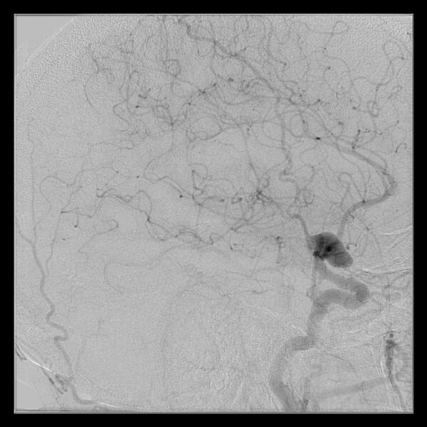 File:Cerebral aneurysm with rupture (Radiopaedia 29933-30458 LT ICA IC 44).jpg