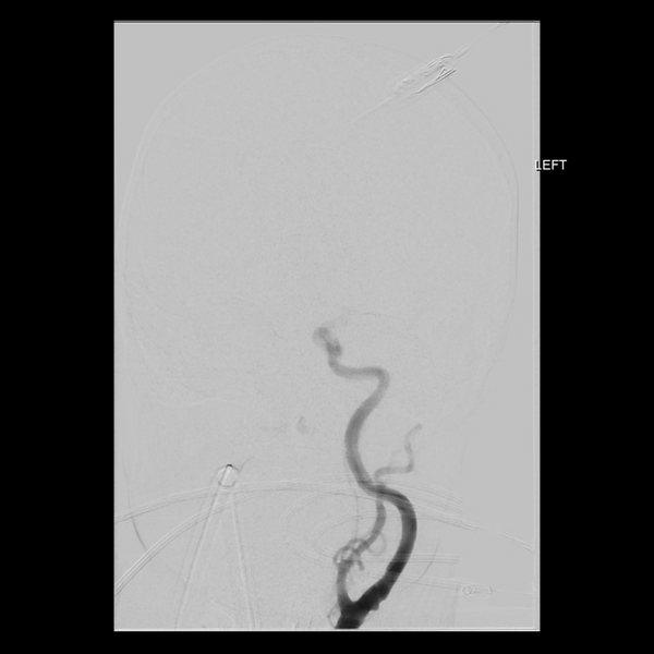 File:Cerebral arteriovenous malformation with lobar hemorrhage (Radiopaedia 44725-48513 LT CCA IC 9).png