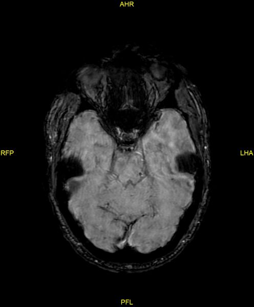 File:Cerebral autosomal dominant arteriopathy with subcortical infarcts and leukoencephalopathy (CADASIL) (Radiopaedia 86108-102054 Axial SWI 40).jpg