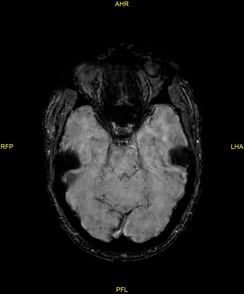 Cerebral autosomal dominant arteriopathy with subcortical infarcts and leukoencephalopathy (CADASIL) (Radiopaedia 86108-102054 Axial SWI 40).jpg