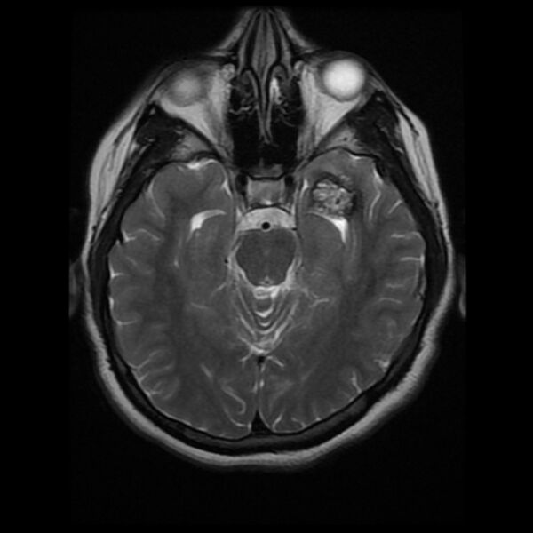File:Cerebral cavernous malformation (Radiopaedia 44301-47942 Axial T2 8).jpg