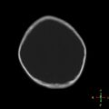 Cerebral contusion (Radiopaedia 48869-53911 Axial bone window 6).jpg