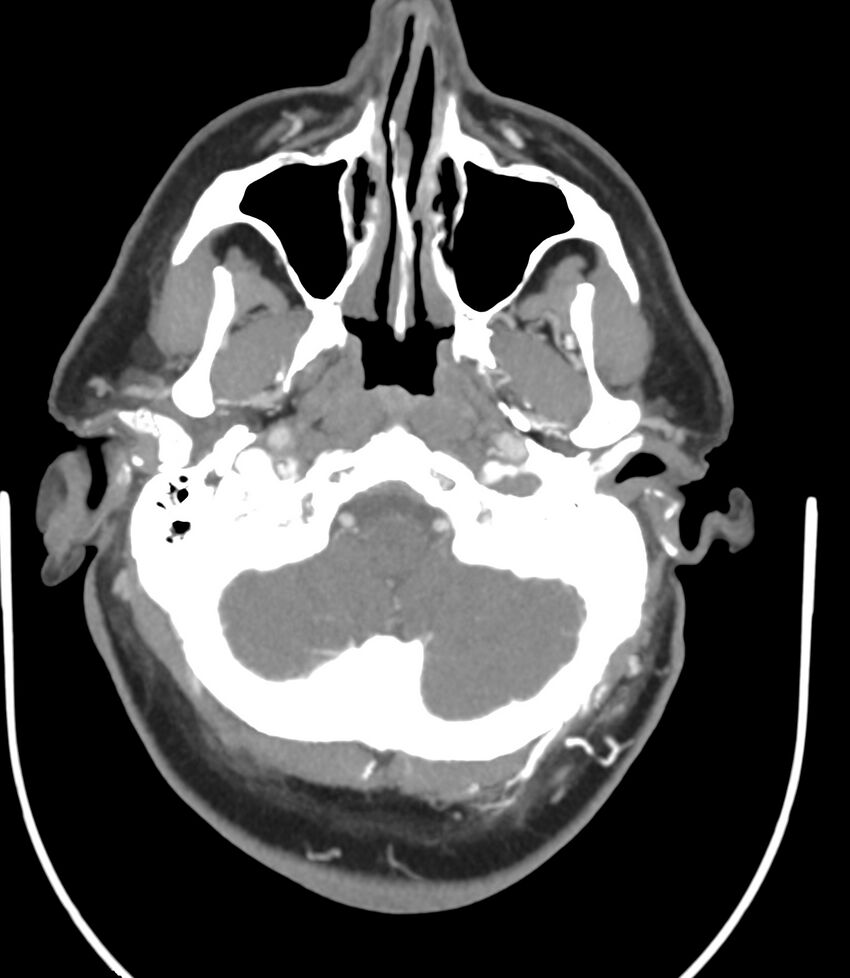 Cerebral dural venous sinus thrombosis (Radiopaedia 86514-102576 A 27).jpg