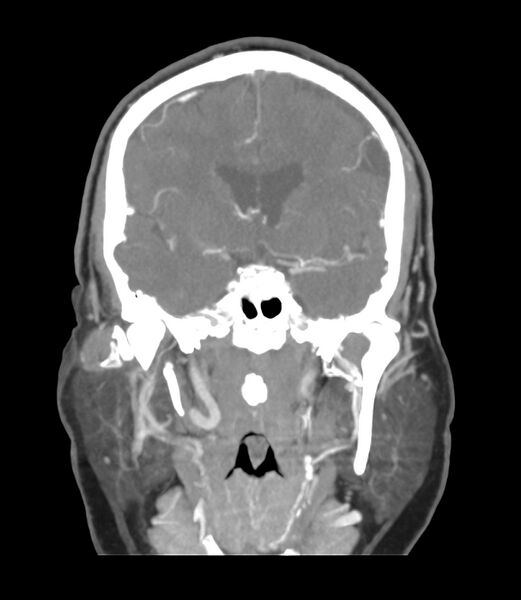 File:Cerebral dural venous sinus thrombosis (Radiopaedia 86514-102576 B 29).jpg