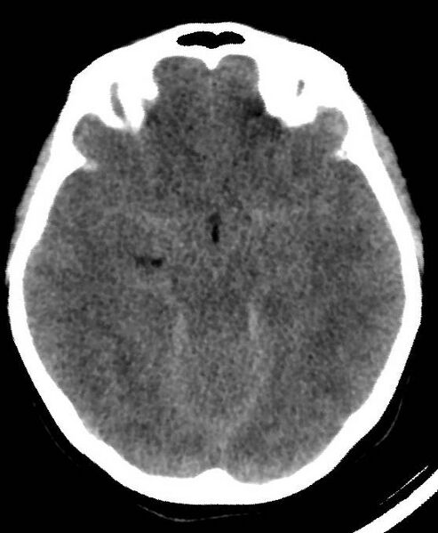 File:Cerebral edema due to severe hyponatremia (Radiopaedia 89826-106937 Axial non-contrast 36).jpg