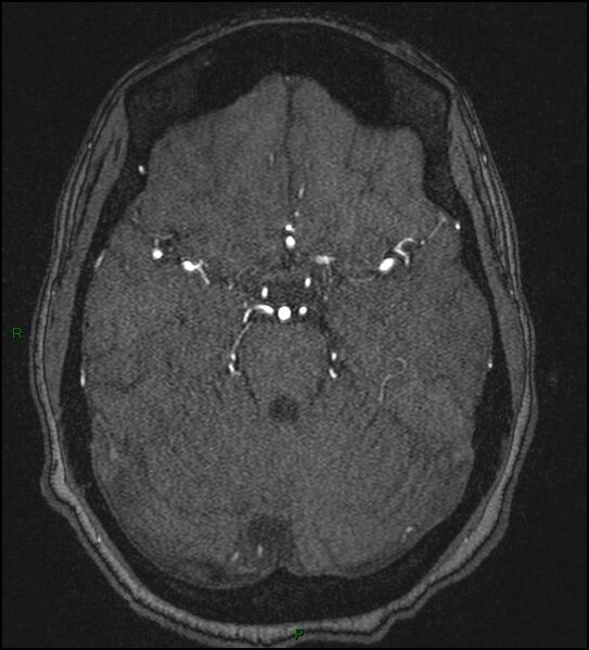 File:Cerebral fat embolism (Radiopaedia 35022-36525 Axial TOF 72).jpg