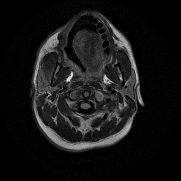File:Cerebral fat embolism (Radiopaedia 37510-39363 Axial FLAIR 1).jpg