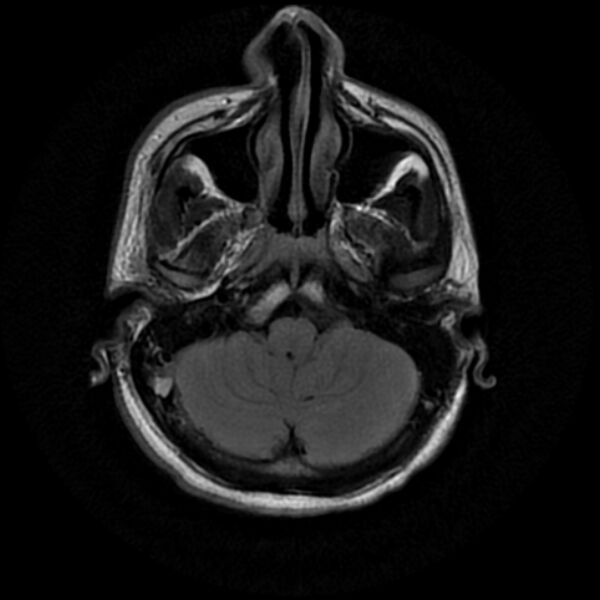 File:Cerebral fat embolism (Radiopaedia 37510-39363 Axial FLAIR 6).jpg