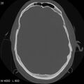 Cerebral hemorrhagic contusion with subdural and subarachnoid hemorrhage (Radiopaedia 10680-11146 Axial bone window 14).jpg